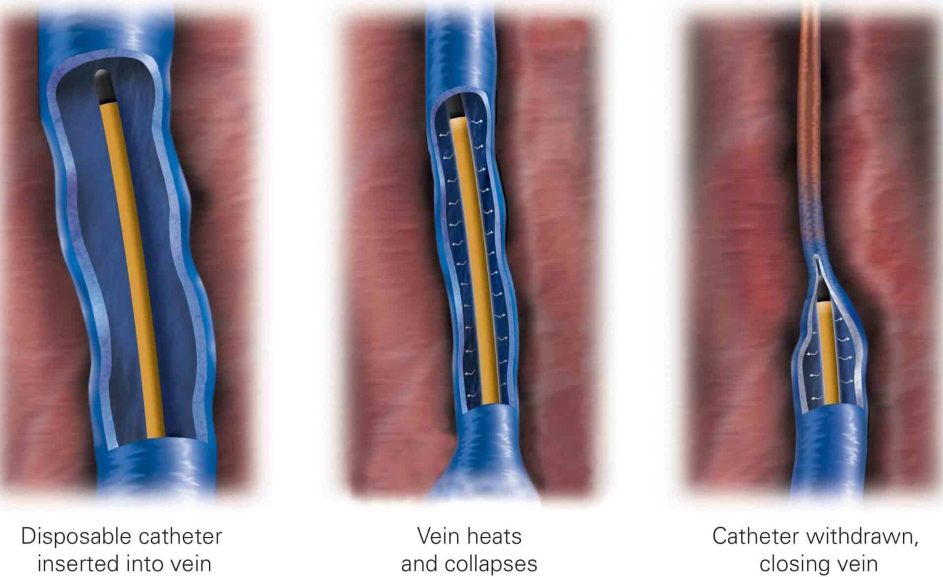 Three steps of endovenous ablation: disposable catheter inserted into the vein, the vein heats and collapses, then the catheter is withdrawn closing the vein