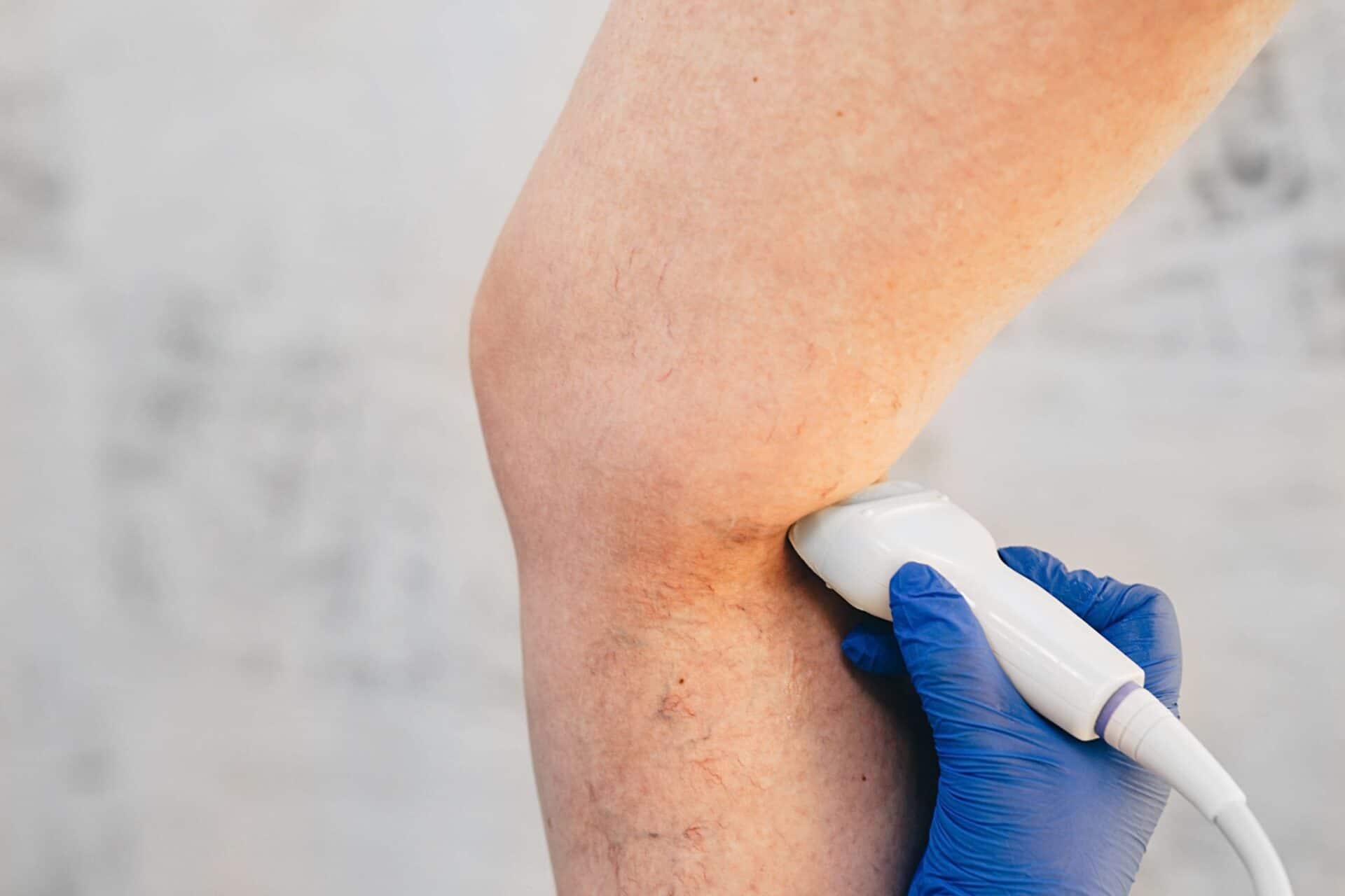 Endovenous Ablation