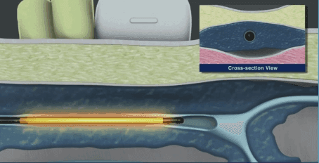 Cross-section view of the catheter inside the vein during endovenous ablation