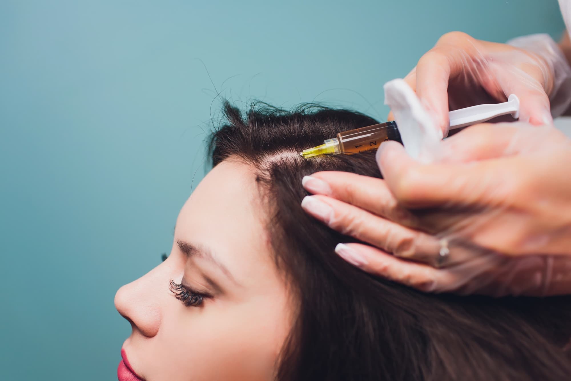 PRP hair loss treatment — platelet-rich plasma being prepared for scalp injection