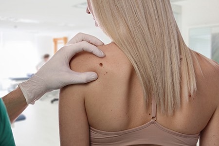 Brown Spots