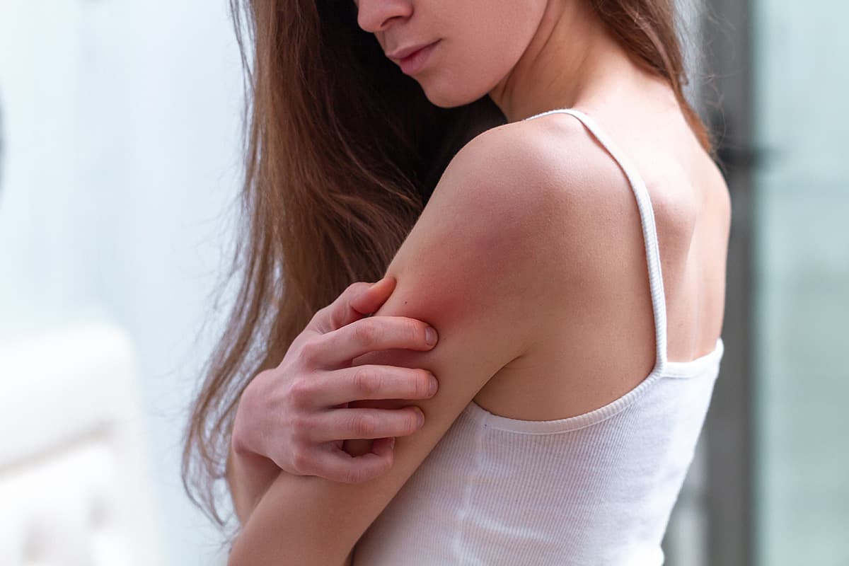 Atopic Dermatitis