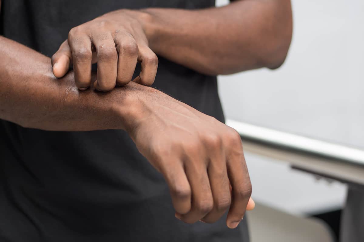 Contact Dermatitis