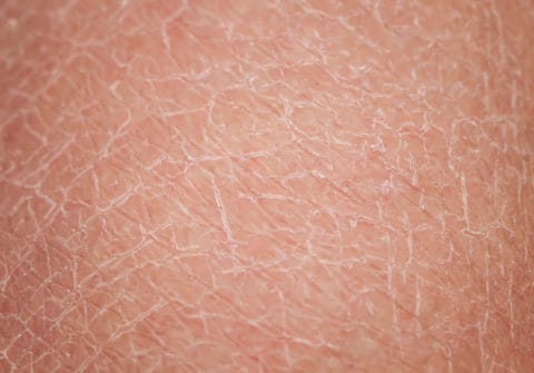 Dry Skin