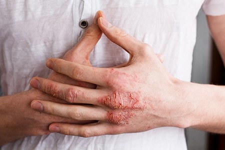Psoriasis