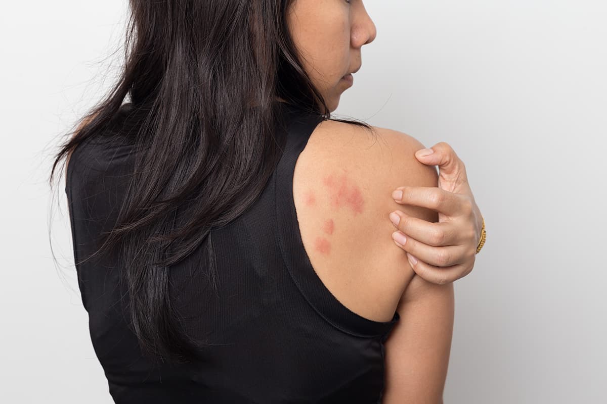 Hives