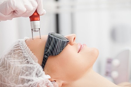 Laser Resurfacing