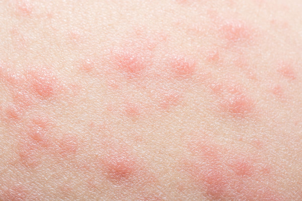 Pityriasis Rosea