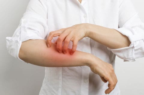 Scabies