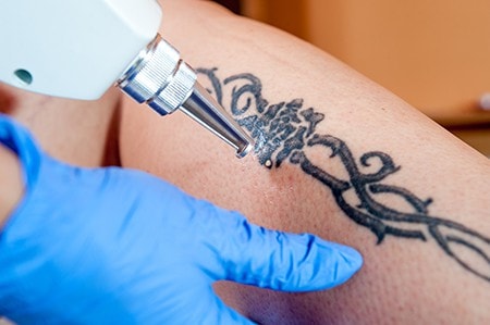 Proffesional Laser Tattoo Removal in Bethesda