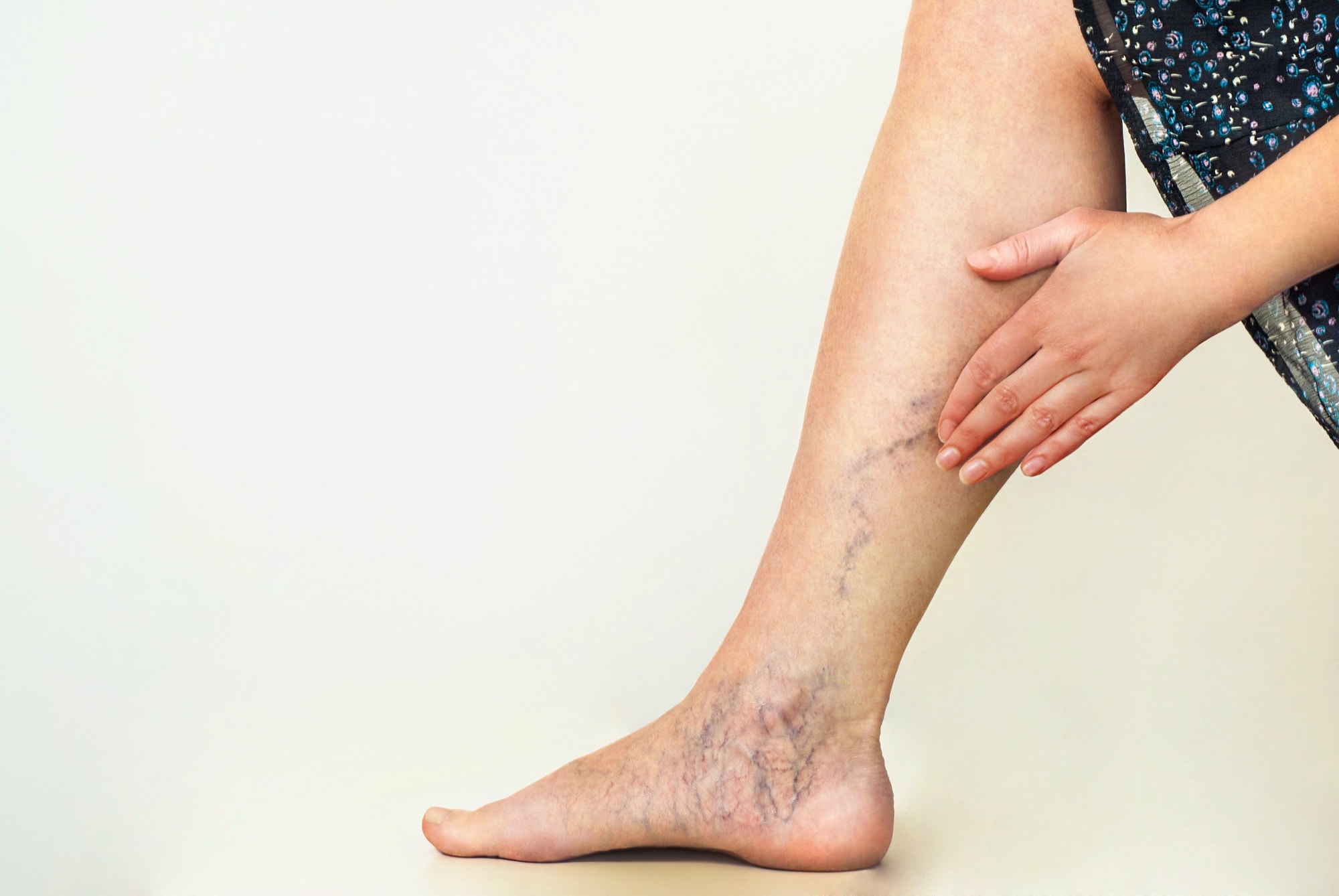 Varicose Veins, Spider Veins, and Dilated Capillaries