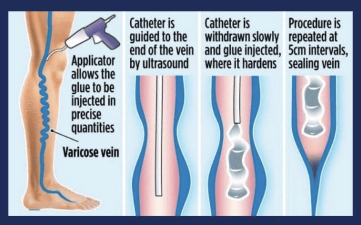VenaSeal™ uses a medical adhesive delivered through a small catheter to close diseased veins and redirect blood flow to healthy veins.