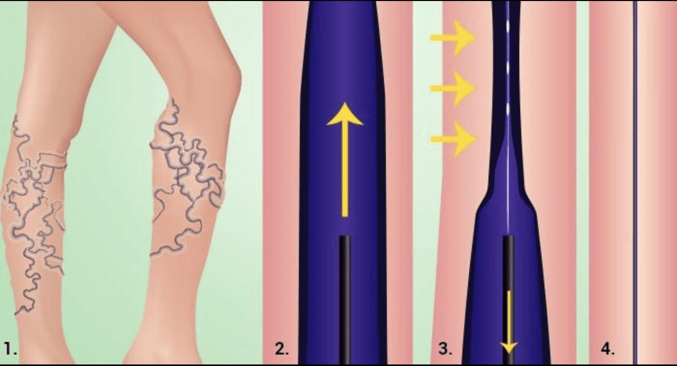 Step-by-step closure of a diseased vein, sealing it so blood reroutes through healthy veins.